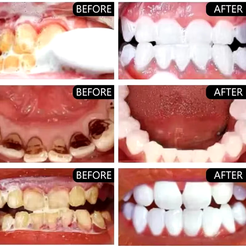5-Day Teeth Whitening Powder — Remove Plaque, Stains & Bad Breath