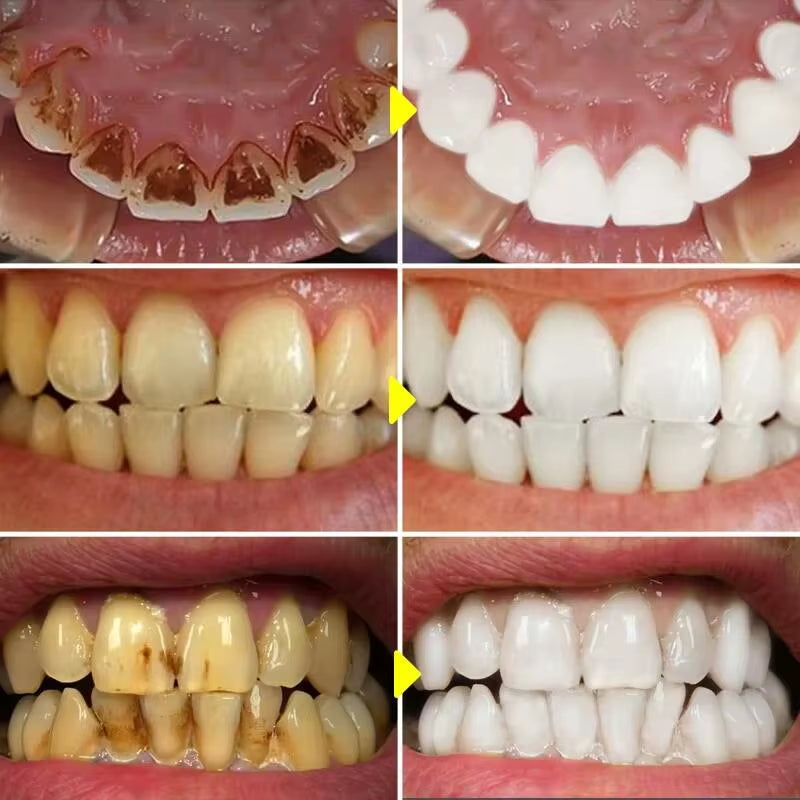 5-Day Teeth Whitening Powder — Remove Plaque, Stains & Bad Breath